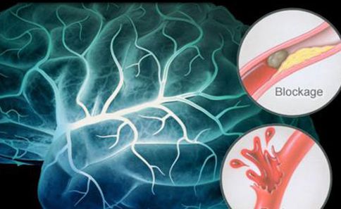 Stroke patients can be treated with stem cell therapy