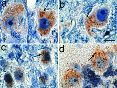 TMEM230 gene mutation can cause Parkinson\'s disease