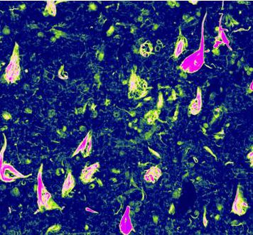 Rare dementia-vacuolar tau disease found