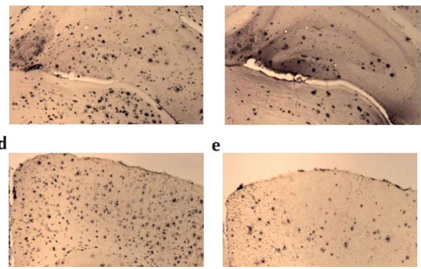 Killing Alzheimer\'s disease may rely on new engineered proteins