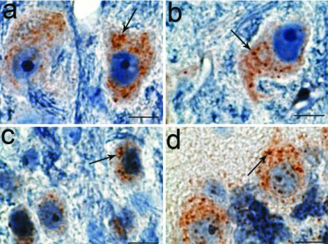 Parkinson\'s disease can come from mutations in the TMEM230 gene