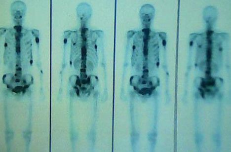 US researchers \\\"cure\\\" myeloma with measles virus