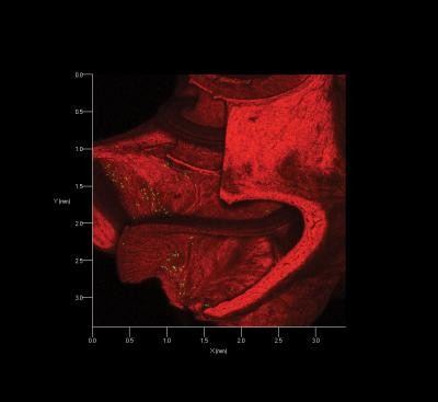 Cochlear implants have been upgraded due to gene therapy