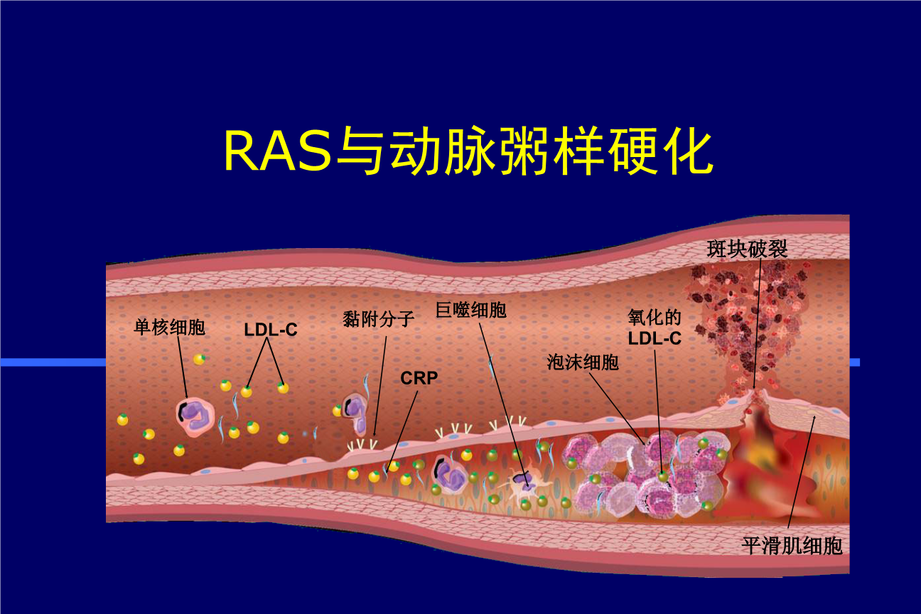 【Animal Modeling】-A study on the combination of disease and syndrome of atherosclerosis (Qi stagnation and blood stasis syndrome) in rats